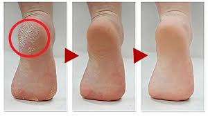 Sea salt does not contain additives. Extreme Dry Cracked Feet Skin Removal How To Get Rid Of Calluses On Feet Dead Skin Foot Peel Youtube