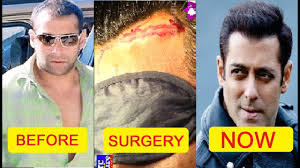 Salman Khan Hair Plantation Surgery Salman Khan Hair Transplant Video Youtube You can get a celebrity hair transplant like salman khan provided that you choose an excellent hair transplant surgeon.