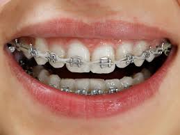 Read customer reviews & find best sellers. Just Got New Braces What Should I Do The Look Orthodontics