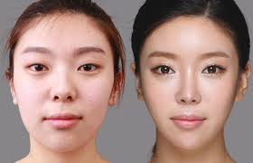 Pin On Plastic Surgery Before And After