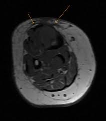Tibial Metastases In Carcinoma Breast Mri Sumer S Radiology Blog