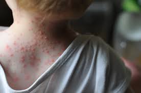 Image result for shingles in children
