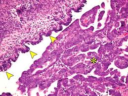 These implants appear like small, flat flecks or patches on the pelvic floor or surface. Mr Imaging Of Malignancies Arising In Endometriomas And Extraovarian Endometriosis Radiographics