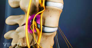 Facet Replacement Or Total Element Replacement Devices For Spinal Stenosis