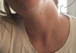 We did not find results for: Lymfaticka Uzlina Na Krku Modry Konik