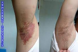王致統醫師的臨床隨筆: 腋下胯下乾癬不會好，小心是黴菌上身！