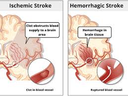 Bildergebnis für CVA