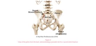 Brake system diagram tapered wear a gradual slope of the pad material creating uneven thickness on either end of the pad. Upper Buttock Pain Sacro Illiac Joint Area Pain