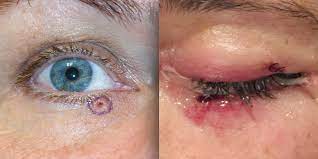 Click images to start gallery (warning: Smeared Mascara Beauty Mark Eyelid Bump Were Skin Cancer