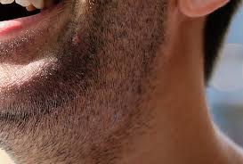 Pickel auf der zunge können unangenehm und schmerzhaft sein. Wie Kann Man Gegen Pickel Im Bart Mithilfe Von Laserbehandlungen Vorgehen Aesthetische Dermatologie Und Lasermedizin