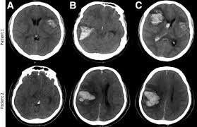 Clinical manifestations can include headache, papilledema, visual loss, focal or generalized seizures, focal neurologic deficits, confusion, altered consciousness, and coma. Decompressive Surgery For Malignant Cerebral Venous Sinus Thrombosis A Retrospective Case Series From Pakistan And Comparative Literature Review Journal Of Stroke And Cerebrovascular Diseases