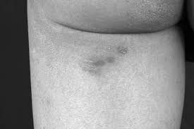 Simplex virus hsv2 on buttocks (1). Recurrent Lumbosacral Herpes Simplex In Two Men Sexually Transmitted Infections