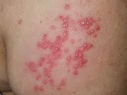 Este important, zic aceștia, să luați măsuri de precauție, în special dacă sunteți aproape de cineva care are un sistem imunitar slăbit și dacă aveți răni deschise, pe care ar fi bine să le acoperiți. Zona Zoster Cauze Manifestari Si Remedii Dr Mihai Lupu