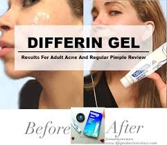 Adapalene was approved by the fda in 1996, but it was only available as a prescription product. Differin Gel Results For Adult Acne And Regular Pimple Review
