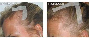 Also, there are at least 5 topics i read on addforums that had some people with similar hair loss problems. Fashionnfreak Female Hair Loss Treatment