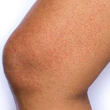 These bumps can appear anywhere, but they're often found on the upper arms and thighs. Keratosis Pilaris Treatment Utah Valley Dermatology