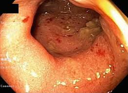 Image result for Proctitis