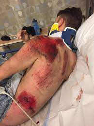 If you follow the treatment steps above and don't encounter infection, your wound should heal within a couple of weeks. My First Bad Case Of Road Rash Stay Safe Out There Velo