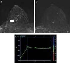 For example, certain types of skin cancer can be diagnosed initially just by visual. Typical Finding Of An Mri Detected Breast Cancer Arrow In This Case Download Scientific Diagram