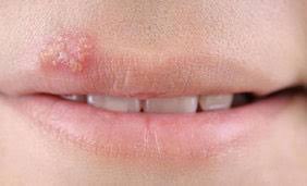 Because the virus can't live long outside your body, you can't catch it from something like a toilet seat or towel. Clinical Presentations Of How Hsv 1 Hsv 2 Can Present