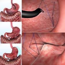 Pin On Endoscopic Sleeve Gastroplasty Esg