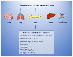 Has the cancer spread to anywhere else in my body? Ijms Free Full Text Breast Cancer Derived Extracellular Vesicles In Bone Metastasis Induction And Their Clinical Implications As Biomarkers Html