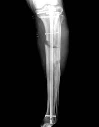 And it seems to be related to the. Fractures Of The Tibia Musculoskeletal Key