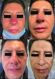 Nasal Tip Abscess: A Rare Infection of the Head and Neck