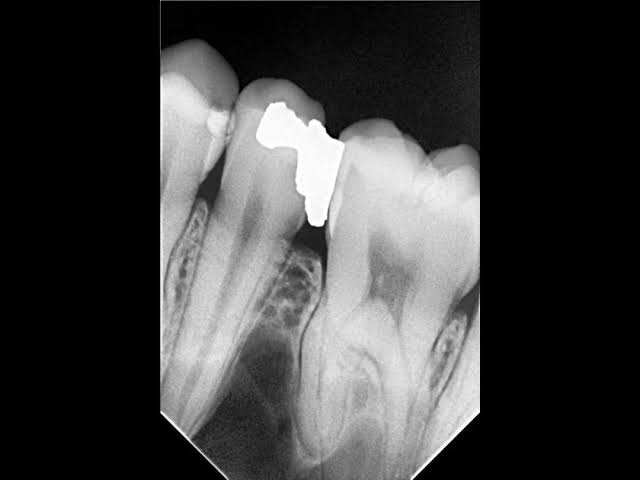Plan for treatment of overhang.The doctor says the space between the teeth  is too large so leave it there for now but just need a second opinion :  r/askdentists