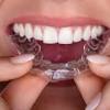 The braces will come off easily and quickly from the teeth. 1