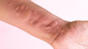 Image result for Vasculitis