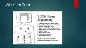 The rush exam (rapid ultrasound in shock examination), presented in this article, represents a comprehensive algorithm for the integration of bedside ultrasound into the care of the patient in shock. Image Slidesharecdn Com Rushexam 160901031023 9