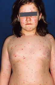 Syphilis is a sexually transmitted disease. Infektionskrankheiten Springerlink