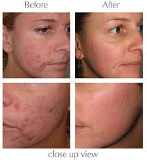 Maybe you would like to learn more about one of these? Acne Treatment Melbourne Acne Scarring Yarra Valley Exposed Skin Care Pimples Overnight How To Get Rid Of Pimples