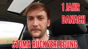 Stoma Ruckverlegung 1 Jahr Nach Der Op Der Grosse Ruckblick Colitis Ulcerosa Youtube