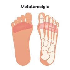 Image result for Metatarsalgia