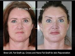 Maybe you would like to learn more about one of these? Pin Auf Cosmetic Surgery
