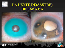 Cambiar El Color De Los Ojos El Desastre De La Lente De Panama Blog De Ojos Innova Ocular Dr Soler