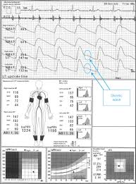 Full Text Pitfalls In The Ankle Brachial Index And Brachial