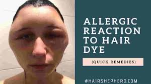 Allergic Reaction To Hair Dye Never Again Remedies Hairshepherd