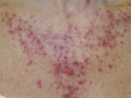 This particular cream is a topical chemotherapy applied to the skin in areas where sun damage has occurred. Efudex Fluorouracil The Skin Center Board Certified Dermatologists Excellence In Medical Surgical And Pediatric Dermatology
