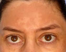 Estoy Embarazada Y Tengo Manchas Oscuras En La Piel Me Ha Salido Un Cloasma En El Rostro