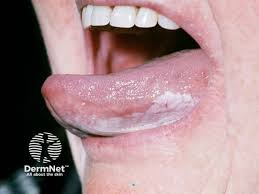 Image result for spinocellular carcinoma of the oral cavity