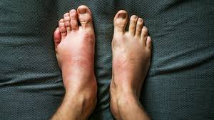 Less frequently, it may occur in other areas, including knees and elbows. Swelling Is It Serious Symptoms Causes And Treatment