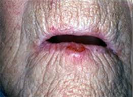 Image result for spinocellular carcinoma of the oral cavity