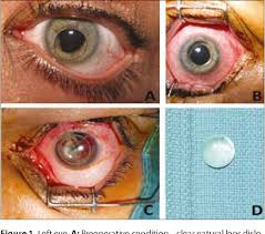 Image result for Lens Dislocation