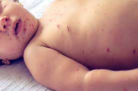 Image result for Measles