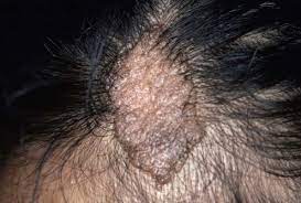 Nevus sebaceous of jadassohn (nsj), also known as organoid nevus or pilosyringosebaceous nevus is an infrequent hamartoma, evolving from a disorder in epithelial, sebaceous, pilar, and apocrine structures. Nevus Sebaceus Plastic Surgery Key