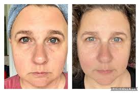 Denise just shared her collagen results. Here are her words: “I've been  pretty quiet about my Collagen results but I still can't stop smiling about  them 😃 Started Jan 2022 and today,