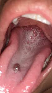 Me Salio Esos Granitos Pero Sin Dolor En La Lengua Ayudaaa Resuelto